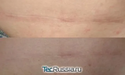 Cum de a elimina cicatrice (cicatrice) dupa cezariana - unguente, laser resurfacing, tatuaje, plastic și alte