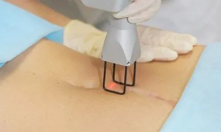 Cum de a elimina cicatrice (cicatrice) dupa cezariana - unguente, laser resurfacing, tatuaje, plastic și alte