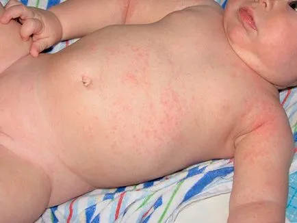 Hogyan törődik a baba bőrét nyári kezelése pelenkakiütés, malária és bőrgyulladás