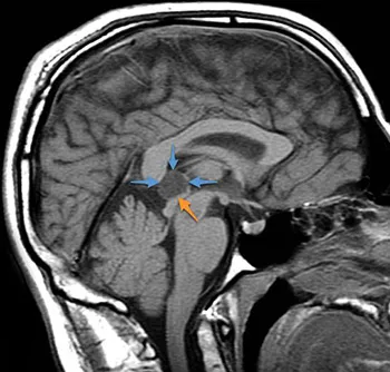 Нематода на епифизната жлеза на мозъка води, последици и лечение на заболяване