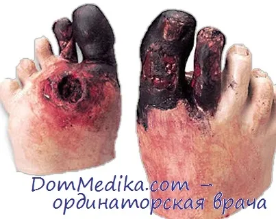 Diabetici Foot Clinica