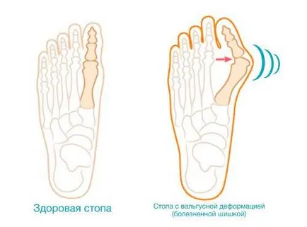 Комбинирана плосък (смесен) лечение, степента на