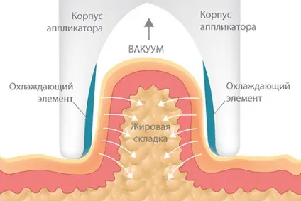 Кріоліполіз (кріоліпосакція) ефект, протипоказання, відгуки, ціна і фото (протипоказання) Кріоліполіз (кріоліпосакція) ефект, протипоказання, відгуки, ціна і фото