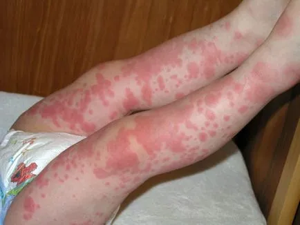 Urticaria pe picioare de un adult și un copil - cauze, tratament