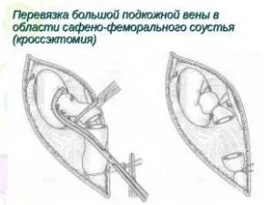 Crossectomy elkészítése és üzemeltetése során, a rehabilitáció után crossectomy