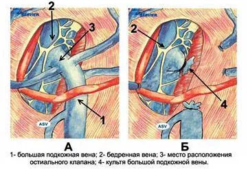 Crossectomy vénák (Troyanova-Trendelenburg működés)