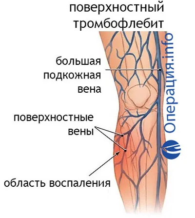 Crossectomy vénák (Troyanova-Trendelenburg működés)