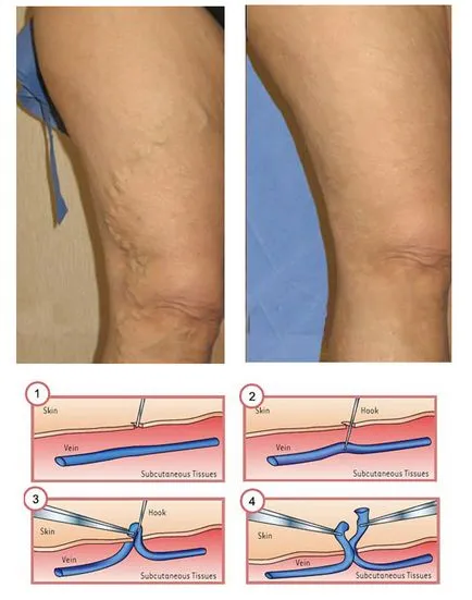 Venele Crossectomy (funcționare Troyanova-Trendelenburg)