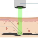 Îndepărtarea cu laser de avantaje și dezavantaje tatuaje