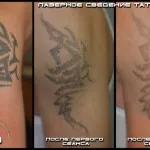 Îndepărtarea cu laser de avantaje și dezavantaje tatuaje