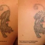 Îndepărtarea cu laser de avantaje și dezavantaje tatuaje