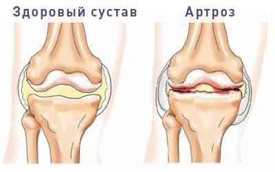 Лечение на остеоартрит без операция