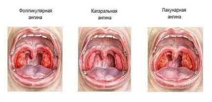 Lacunar amigdalită cauze, simptome, tratament si prevenire