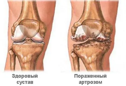 Tratamentul osteoartritei eficiente metode, medicamente, unguente si pastile