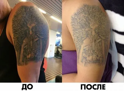 Îndepărtarea cu laser de avantaje și dezavantaje tatuaje