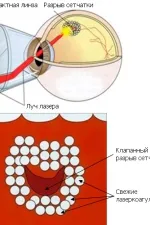 Лечение на периферните дистрофии на ретината, общинска болница № 40