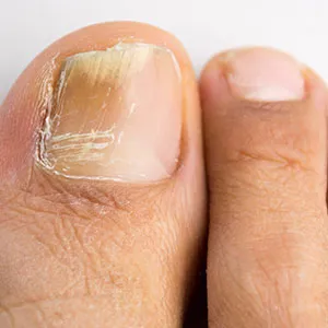 Лечение на гъбички на ноктите оцет в домашни условия