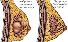 Mell fibrocisztás mérsékelt és diffúz