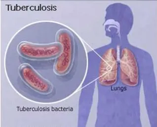 Митове и истината за туберкулоза
