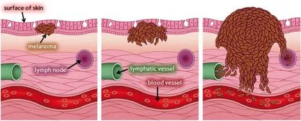 Metasztázisok melanoma áttétet, hogyan kell kezelni, hogy mi előrejelzése