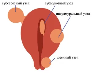 Hysteromyoma причинява симптоми и методи за лечение, за лечение на маточни фиброиди, делеция, миома