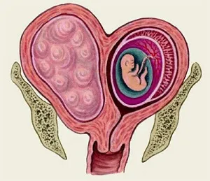 Hysteromyoma причинява симптоми и методи за лечение, за лечение на маточни фиброиди, делеция, миома