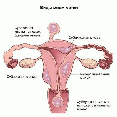 Рак на шийката на Ьибооили причини, видове, симптоми, лечение