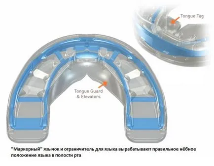 Modelul Miobreys, principiul de funcționare, avantaje față de aparat dentar