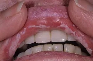 A szájpenész (candidiasis) az okok, amelyek az ajkak, tünetek és kezelés