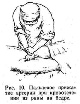 Кровотеча, його види та способи зупинки (вище місця поранення) Кровотеча, його види та способи зупинки