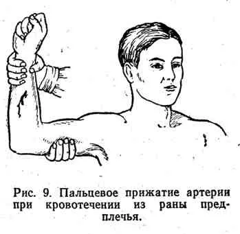 Кровотеча, його види та способи зупинки (способи) Кровотеча, його види та способи зупинки