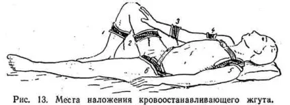Кровотеча, його види та способи зупинки (зупинки) Кровотеча, його види та способи зупинки
