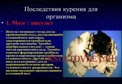 Куріння після інсульту небезпеку і шкоду електронних сигарет (інсульту) Куріння після інсульту небезпеку і шкоду електронних сигарет