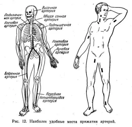 Кровотеча, його види та способи зупинки (зупинки) Кровотеча, його види та способи зупинки