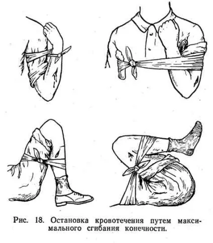 Кровотеча, його види та способи зупинки (вище місця поранення) Кровотеча, його види та способи зупинки