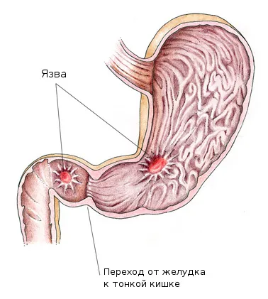 Възможно ли е язва мед