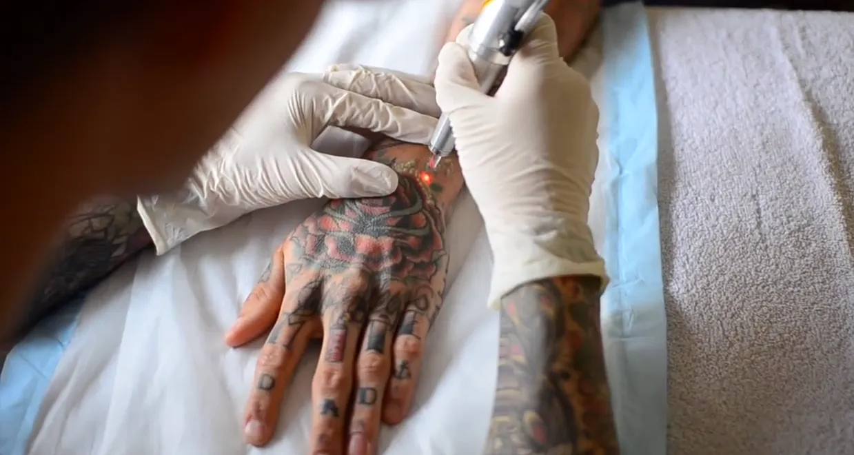 Ami arról, hogy távolítsa el a lézeres tetoválás fáj