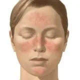 Népi jogorvoslati kezelésére rosacea - kezelőorvosát Aibolit