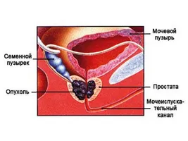 Cum în mod eficient dousing prostatei