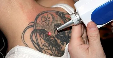 Ami arról, hogy távolítsa el a lézeres tetoválás fáj