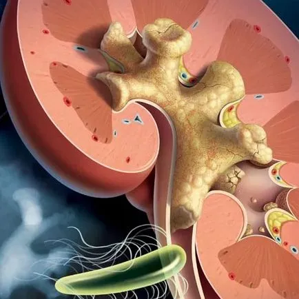 Nephroptosis наляво и че тя е резултат от бъбречни заболявания