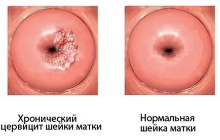 Nolitsin cistita aplicație particulară