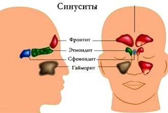 Descrierea metodelor de tratament a bolilor sinusurilor paranazale