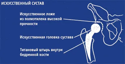 Оперативне лікування коксартрозу