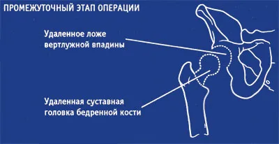 Оперативне лікування коксартрозу