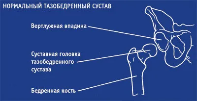 Оперативне лікування коксартрозу