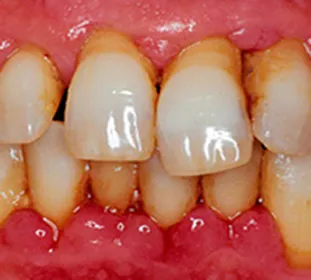 A periodontitis besorolás (krónikus, generalizált, és mások), okoz, a tünetek, és a