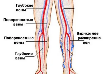 Първите признаци на разширени вени симптоми на често срещани заболявания