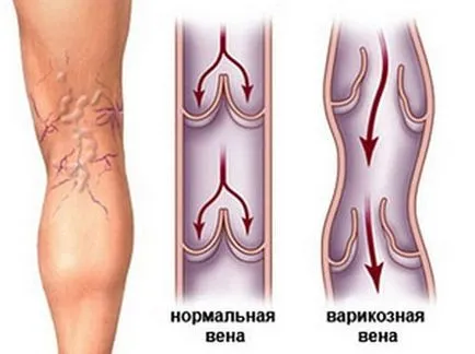 Първите признаци на разширени вени симптоми на често срещани заболявания