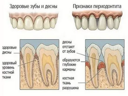 parodontită cronică metode de tratament chirurgical proffilaktiki
